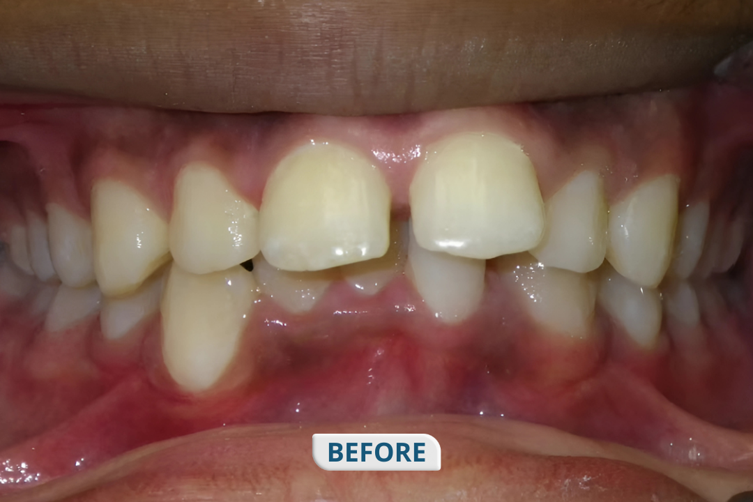 Before treatment at Namira Oro Dental Care